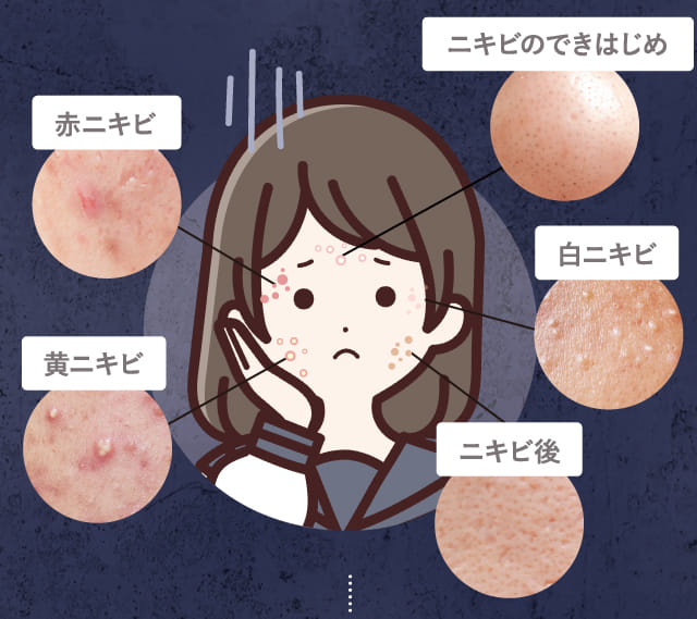 ニキビのできはじめ 赤ニキビ 黄ニキビ 白ニキビ ニキビ後
